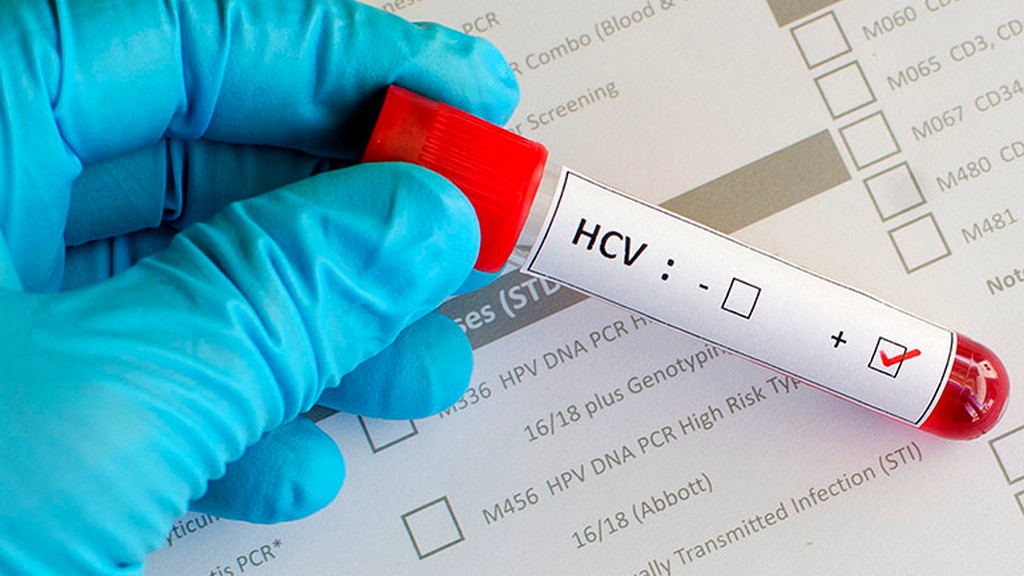 Anti HCV Testi