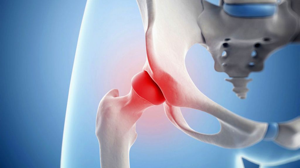 Çimentolu Kalça Protezi - Polietilen Kalça Protezi