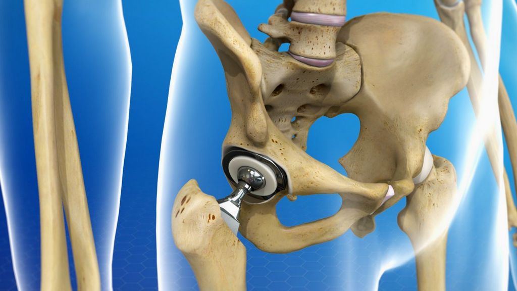 Çimentolu Kalça Protezi