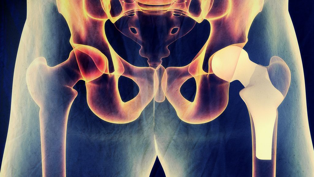 Çimentosuz Femoral Sistemler