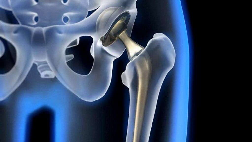 Çimentosuz Kalça Protezi