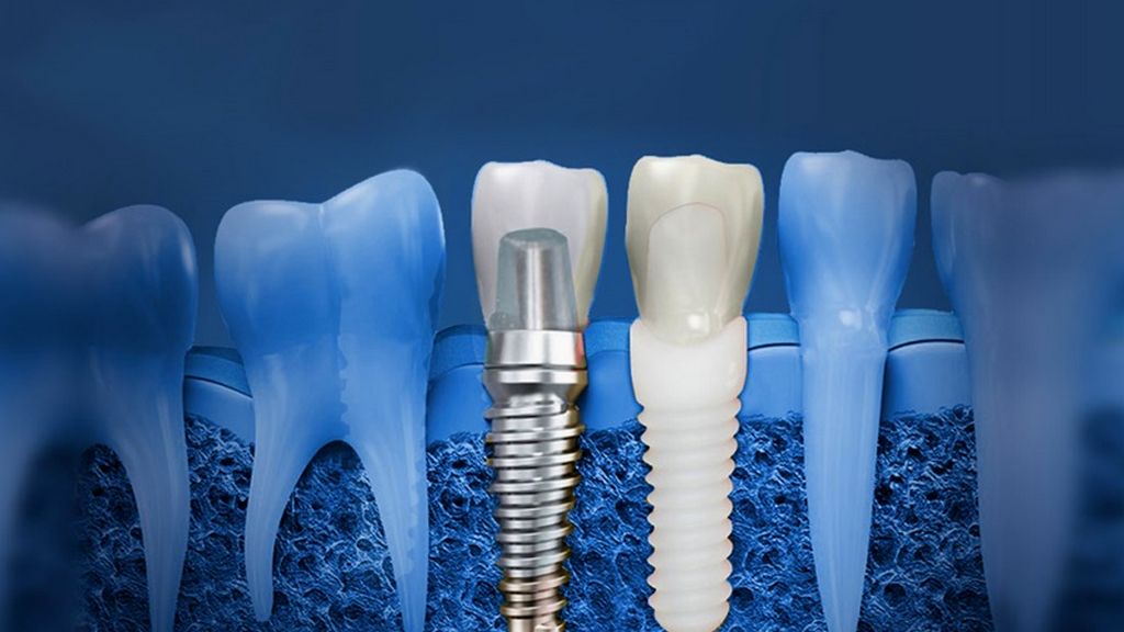 Dental İmplantlar - Kemik Seviyesi Ölçü Transfer Parçaları