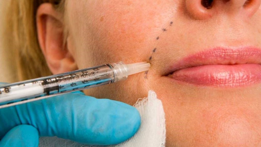 Dermal Dolgu Kanülü