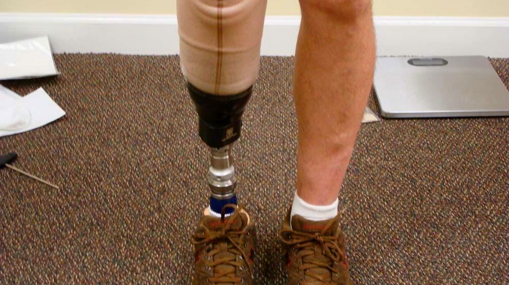 Diz Üstü Bacak Protezi - Geçici Protez Uygulaması