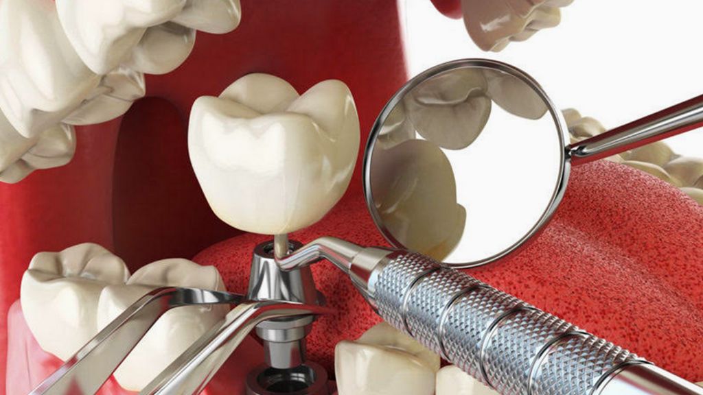 Doku Seviyesi - Kapalı Ölçü Transfer Parçası