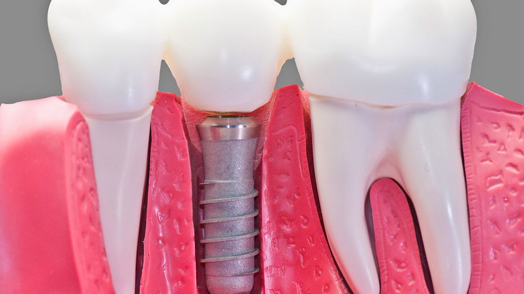 Doku Seviyesi - Vida Tutuculu Açık Ölçü Transfer Parçası