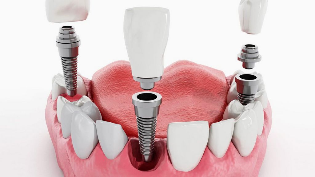 Doku Seviyesi - Vida Tutuculu Düz Analog