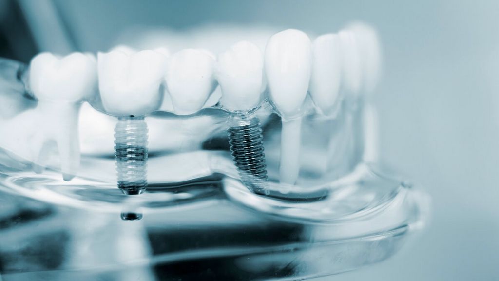 Doku Seviyesi - Vida Tutuculu Kapalı Ölçü Transfer Parçası