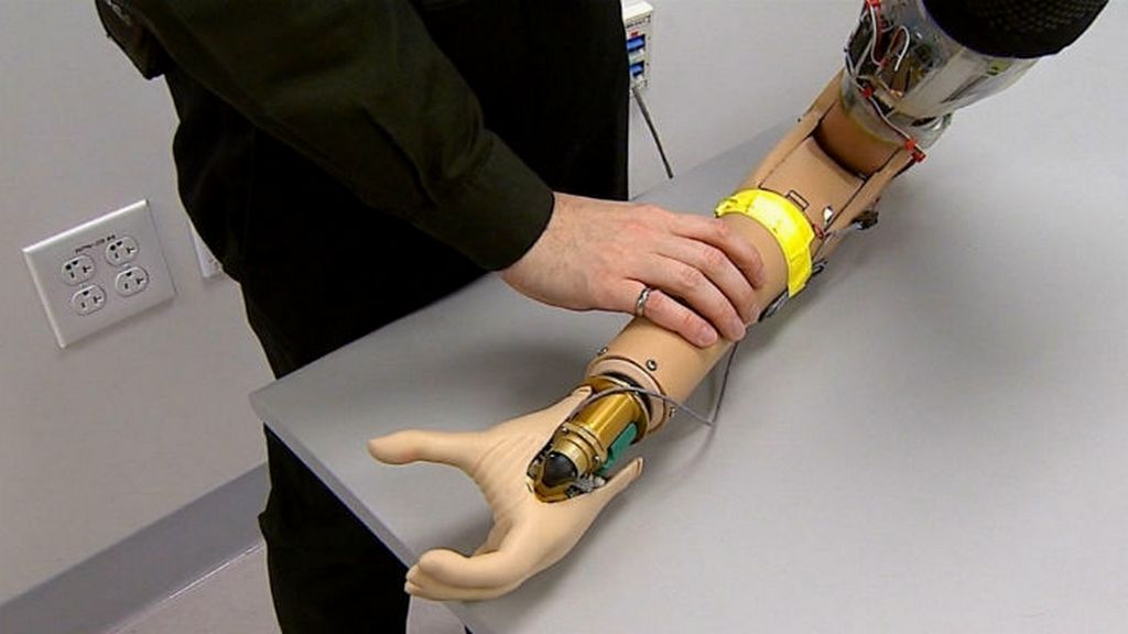 Fonksiyonel Dirsek Üstü Protezler