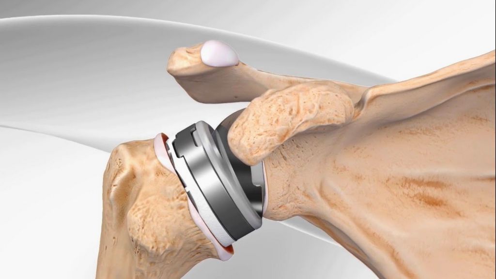 Fonksiyonel Omuz Dezartikülasyon Protezi