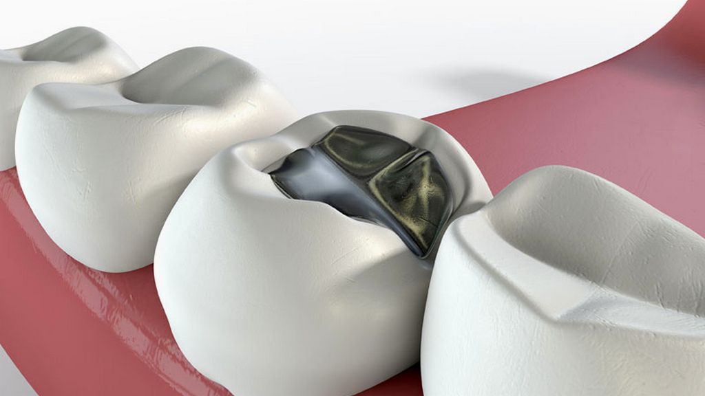 Materiales de relleno de canales temporales