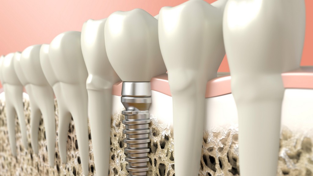 Dental İmplant Ölçü ve Transfer Parçaları