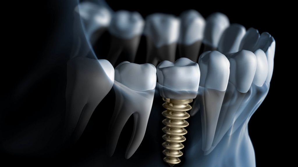 Kemik Seviyesi - Açık Ölçü Transfer Parçası