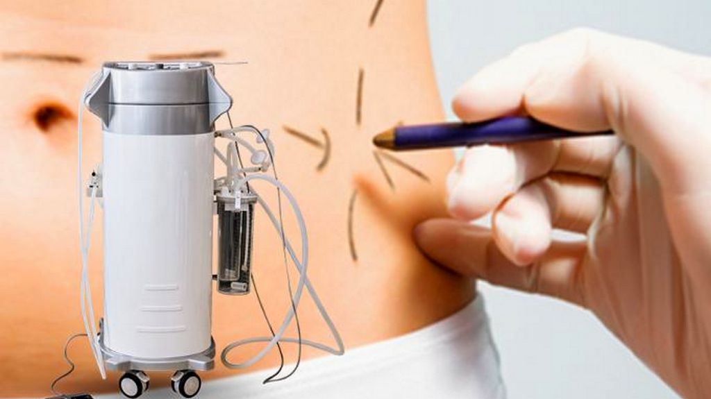 Liposuction Aspiratör ve Ekipmanları