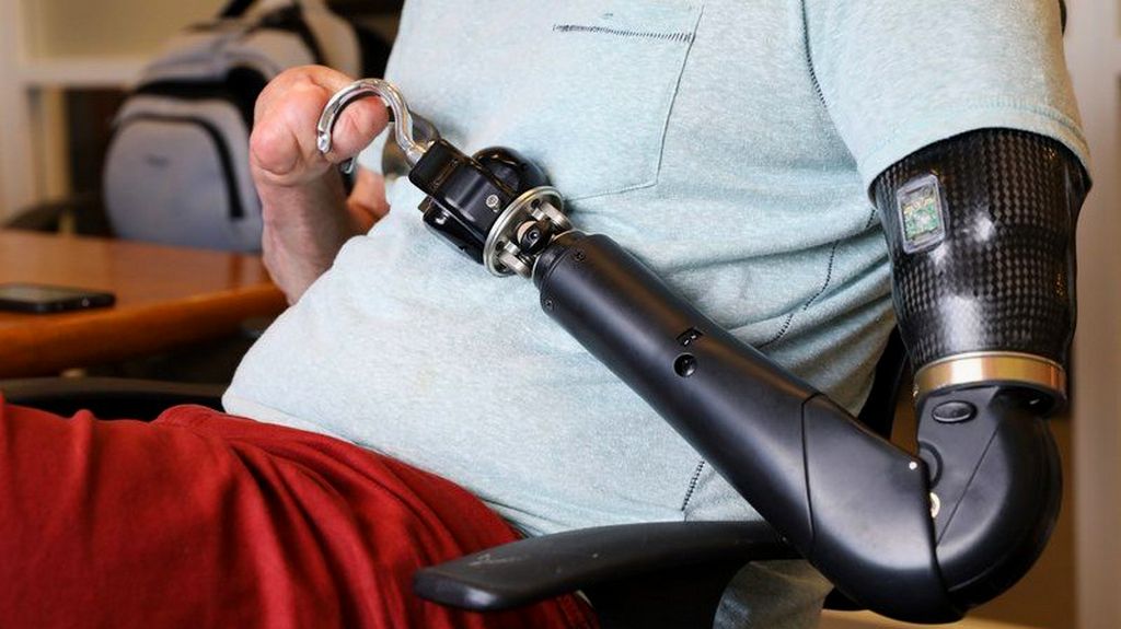 Mekanik Dirsek Üstü Protezler