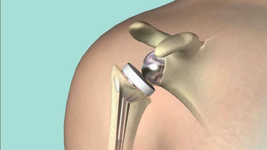 Ortopedi Cerrahi - Kemik Kesici Pensler