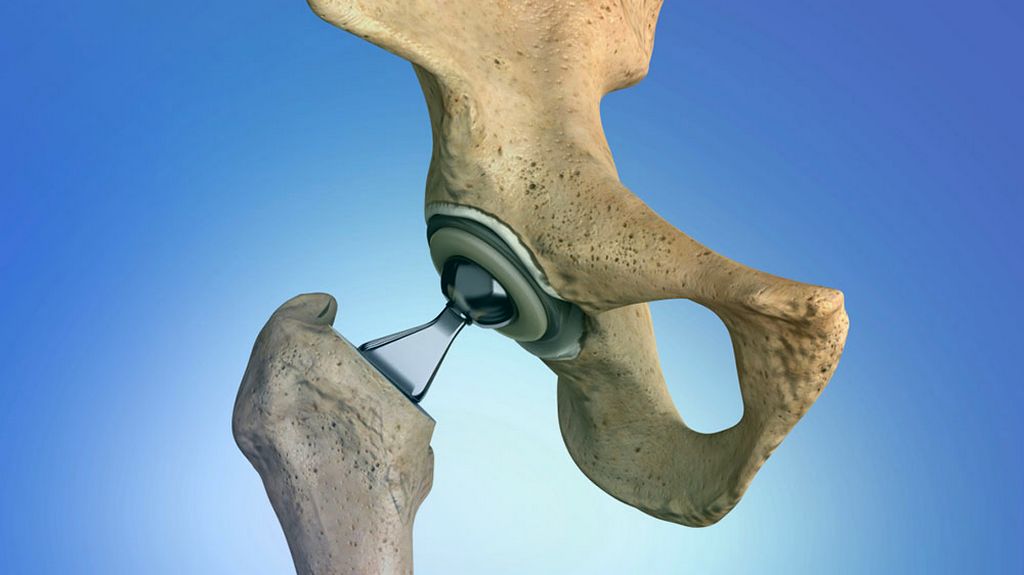 Ortopedi Cerrahi - Kemik Levyeleri