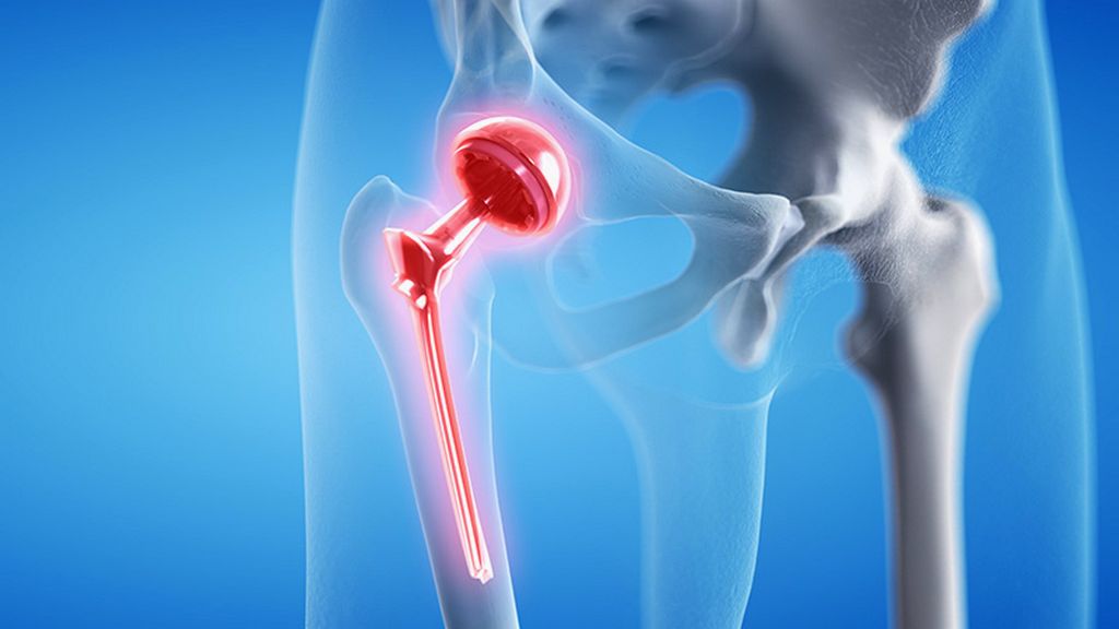 Revizyon Femoral Sistemler