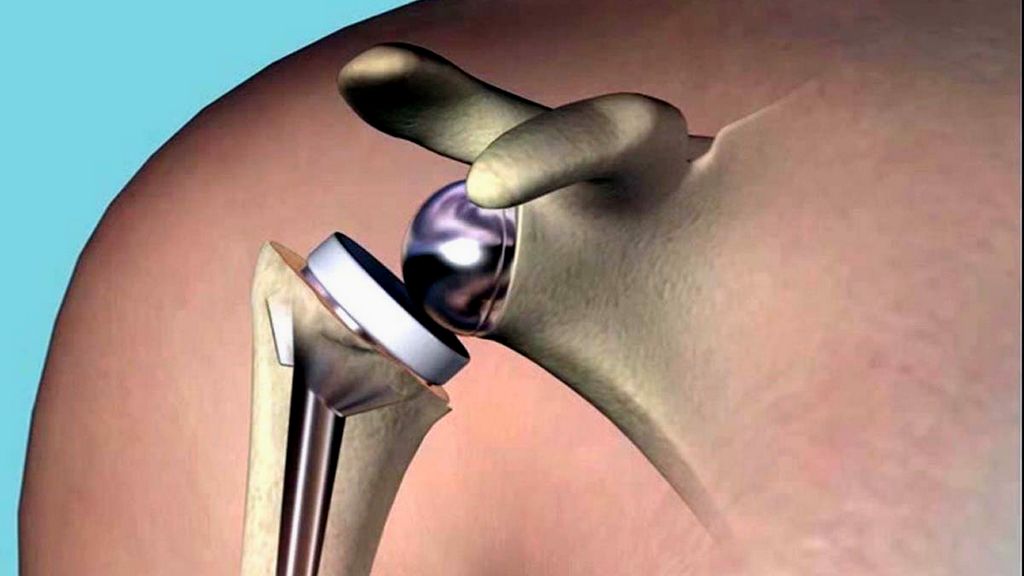 Standart Anatomik Protezler